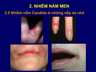 2.5 Nhiễm nấm Candida ở những nếp da nhỏ
2. NHIỄM NẤM MEN
 