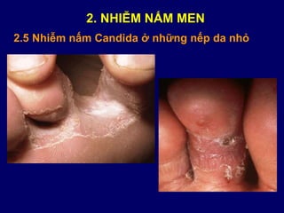 2.5 Nhiễm nấm Candida ở những nếp da nhỏ
2. NHIỄM NẤM MEN
 