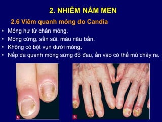 • Móng hư từ chân móng.
• Móng cứng, sần sùi, màu nâu bẩn.
• Không có bột vụn dưới móng.
• Nếp da quanh móng sưng đỏ đau, ấn vào có thể mủ chảy ra.
2.6 Viêm quanh móng do Candia
2. NHIỄM NẤM MEN
 