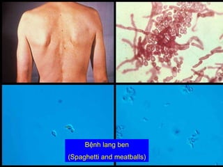 JSH
Bệnh lang ben
(Spaghetti and meatballs)
 