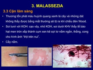 3.3 Cận lâm sàng
• Thương tổn phát màu huỳnh quang xanh lá cây và những dát
không thấy được bằng mắt thường sẽ lộ ra khi chiếu đèn Wood.
• Soi tươi với KOH: cạo vảy, nhỏ KOH, soi dưới KHV thấy tế bào
hạt men tròn xếp thành cụm xen kẽ sợi tơ nấm ngắn, thẳng, cong
cho hình ảnh “thịt trên nui”.
• Cấy nấm.
3. MALASSEZIA
 