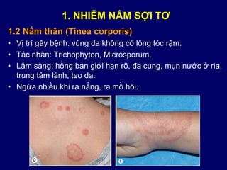 1.2 Nấm thân (Tinea corporis)
• Vị trí gây bệnh: vùng da không có lông tóc rậm.
• Tác nhân: Trichophyton, Microsporum.
• Lâm sàng: hồng ban giới hạn rõ, đa cung, mụn nước ở rìa,
trung tâm lành, teo da.
• Ngứa nhiều khi ra nắng, ra mồ hôi.
1. NHIỄM NẤM SỢI TƠ
 