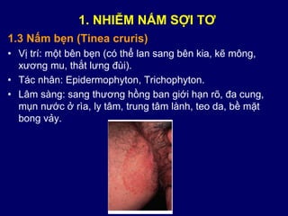 1.3 Nấm bẹn (Tinea cruris)
• Vị trí: một bên bẹn (có thể lan sang bên kia, kẽ mông,
xương mu, thắt lưng đùi).
• Tác nhân: Epidermophyton, Trichophyton.
• Lâm sàng: sang thương hồng ban giới hạn rõ, đa cung,
mụn nước ở rìa, ly tâm, trung tâm lành, teo da, bề mặt
bong vảy.
1. NHIỄM NẤM SỢI TƠ
 