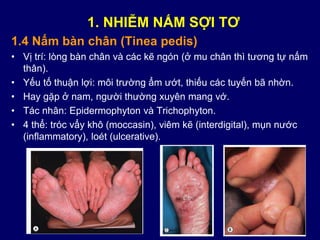 1.4 Nấm bàn chân (Tinea pedis)
• Vị trí: lòng bàn chân và các kẽ ngón (ở mu chân thì tương tự nấm
thân).
• Yếu tố thuận lợi: môi trường ẩm ướt, thiếu các tuyến bã nhờn.
• Hay gặp ở nam, người thường xuyên mang vớ.
• Tác nhân: Epidermophyton và Trichophyton.
• 4 thể: tróc vẩy khô (moccasin), viêm kẽ (interdigital), mụn nước
(inflammatory), loét (ulcerative).
1. NHIỄM NẤM SỢI TƠ
 
