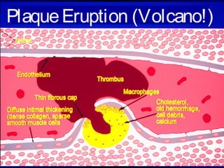 PlaqueEruption (Volcano!)
 