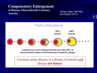 Compensatory Enlargement
of Human Atherosclerotic Coronary
Arteries
N Engl J Med 1987 May
28;316(22):1371-5
<50%
stenosis
Luminal area is not endangered until more than 40% of
internal elastic lamina is destructed and occupied by plaque
Coronary artery disease is a disease of arterial wall
disease not lumen.
PositiveRemodeling
<80%
stenosis
 