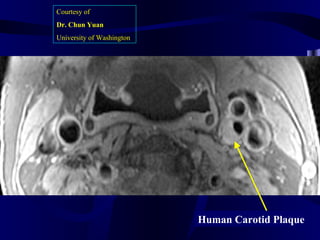 Human Carotid Plaque
Courtesy of
Dr. Chun Yuan
University of Washington
 