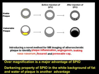 vasa vasorum
Over magnification is a major advantage of SPIO
Darkening property of SPIO in the white background of fat
and water of plaque is another advantage
 