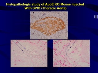 Histopathologic study of ApoE KO Mouse injected
With SPIO (Thoracic Aorta)
CD68 staining
(aortic plaque)
Iron Staining (aortic plaque) Iron Staining (coronary section)
Iron particles Iron particles
 