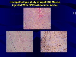 Histopathologic study of ApoE KO Mouse
injected With SPIO (Abdominal Aorta)
H&E staining
Iron Staining CD 68 staining
Iron particles
 
