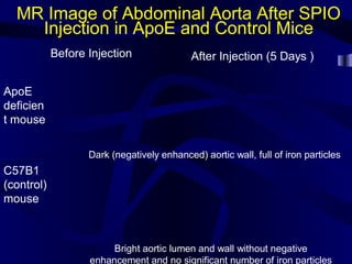 MR Image of Abdominal Aorta After SPIO
Injection in ApoE and Control Mice
ApoE
deficien
t mouse
C57B1
(control)
mouse
Before Injection After Injection (5 Days )
Dark (negatively enhanced) aortic wall, full of iron particles
Bright aortic lumen and wall without negative
enhancement and no significant number of iron particles
 