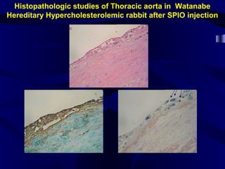 Histopathologic studies of Thoracic aorta in Watanabe
Hereditary Hypercholesterolemic rabbit after SPIO injection
H&E staining
Iron staining Iron staining
Iron particles
 