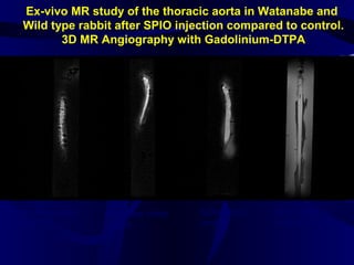 Ex-vivo MR study of the thoracic aorta in Watanabe and
Wild type rabbit after SPIO injection compared to control.
3D MR Angiography with Gadolinium-DTPA
Watanabe rabbit
Post-SPIO
Watanabe rabbit
control
NZW rabbit
control
NZW rabbit
Post-SPIO
 