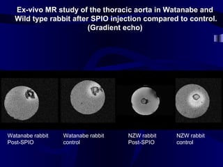 Ex-vivo MR study of the thoracic aorta in Watanabe and
Wild type rabbit after SPIO injection compared to control.
(Gradient echo)
Watanabe rabbit
Post-SPIO
Watanabe rabbit
control
NZW rabbit
Post-SPIO
NZW rabbit
control
 