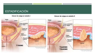 ESTADIFICACIÓN 
T1N0M0 
T2aN0M0 
T2bN0M0 
 