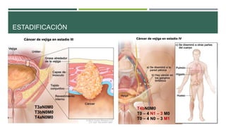 ESTADIFICACIÓN 
T3aN0M0 
T3bN0M0 
T4aN0M0 
T4bN0M0 
T0 – 4 N1 – 3 M0 
T0 – 4 N0 – 3 M1 
 