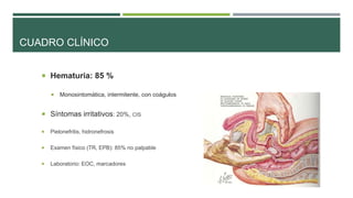 CUADRO CLÍNICO 
 Hematuria: 85 % 
 Monosintomática, intermitente, con coágulos 
 Síntomas irritativos: 20%, CIS 
 Pielonefritis, hidronefrosis 
 Examen físico (TR, EPB): 85% no palpable 
 Laboratorio: EOC, marcadores 
 