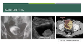 IMAGENOLOGÍA 
TC: útil para estadificación 
 