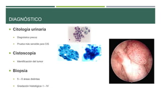 DIAGNÓSTICO 
 Citología urinaria 
 Diagnóstico precoz 
 Prueba más sensible para CIS 
 Cistoscopía 
 Identificación del tumor 
 Biopsia 
 5 – 6 áreas distintas 
 Gradación histológica: I – IV 
 