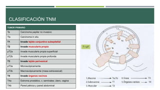 CLASIFICACIÓN TNM 
TUMOR PRIMARIO 
Ta Carcinoma papilar no invasivo 
Tis Carcinoma in situ 
T1 Invade tejido conjuntivo subepitelial 
T2 Invade muscularis propia 
pT2a Invade muscularis propia superficial 
pT2b Invade muscularis propia profunda 
T3 Invade tejido perivesical 
pT3a Microscópicamente 
pT3b Macroscópicamente (masa extravesical) 
T4 Invade órganos vecinos 
T4a Estroma prostático, v. seminales; útero, vagina 
T4b Pared pélvica y pared abdominal 
 