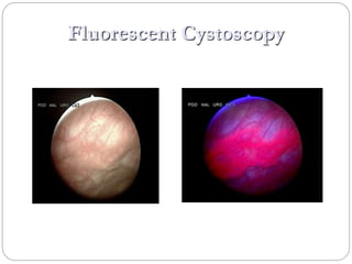 Management of Non Muscle Invasive Bladder Cancer | PPTX