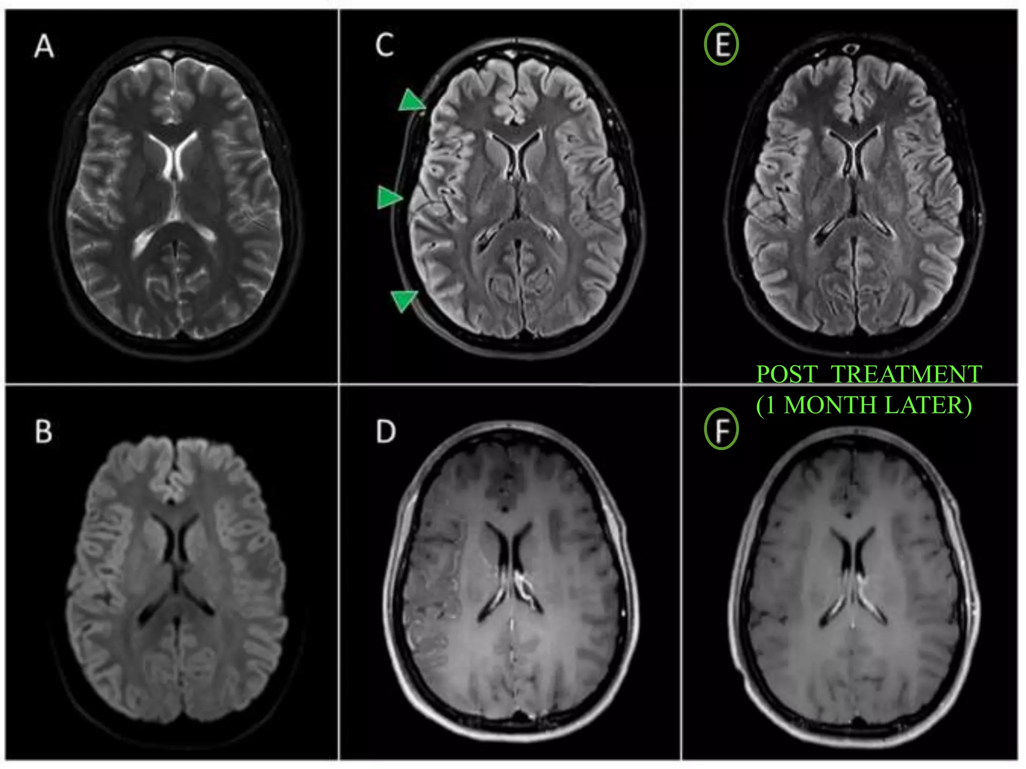 POST TREATMENT
(1 MONTH LATER)
 