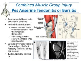 Combined Muscle Group Injury
Pes Anserine Tendonitis or Bursitis
• Anteromedial knee pain,
occasional swelling
• Acute inflammation of:
– one or more of three
conjoined tendons near
their insertion
(tendonitis)
– Bursa lying 2 inches
below the medial knee
joint (bursitis)
• Causes: overuse/ friction
(from valgus, flatfoot,
rotatory stresses, direct
contusion)
• Tx: Ice, NSAIDS, steroid
inj.
NM imaging of blood-
pool showing
hyperemia of synovial
lining (pes anserine
bursitis) and bony
lateral tibial plateau.
Arrow points to
bursitis. (B) MRI shows
large joint effusion and
anserine bursitis
(arrow) in same medial
area of knee as in A.
J. Nucl. Med. Technol. June 2007 vol. 35 no. 2 64-76
 