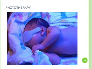 PHOTOTHERAPY
36
 