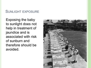 SUNLIGHT EXPOSURE
Exposing the baby
to sunlight does not
help in treatment of
jaundice and is
associated with risk
of sunburn and
therefore should be
avoided.
51
 