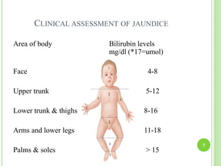 CLINICAL ASSESSMENT OF JAUNDICE
Area of body Bilirubin levels
mg/dl (*17=umol)
Face 4-8
Upper trunk 5-12
Lower trunk & thighs 8-16
Arms and lower legs 11-18
Palms & soles > 15
7
 