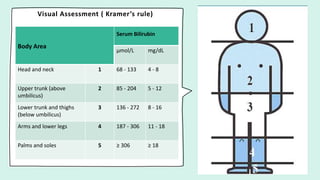 Visual Assessment ( Kramer’s rule)
Body Area
Serum Bilirubin
μmol/L mg/dL
Head and neck 1 68 - 133 4 - 8
Upper trunk (above
umbilicus)
2 85 - 204 5 - 12
Lower trunk and thighs
(below umbilicus)
3 136 - 272 8 - 16
Arms and lower legs 4 187 - 306 11 - 18
Palms and soles 5 ≥ 306 ≥ 18
 