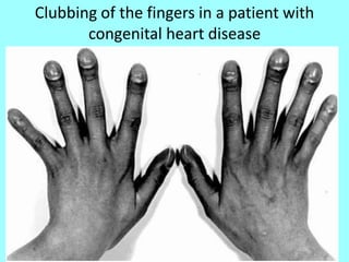 Clubbing of the fingers in a patient with
congenital heart disease
 