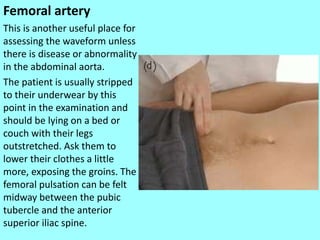 Femoral artery
This is another useful place for
assessing the waveform unless
there is disease or abnormality
in the abdominal aorta.
The patient is usually stripped
to their underwear by this
point in the examination and
should be lying on a bed or
couch with their legs
outstretched. Ask them to
lower their clothes a little
more, exposing the groins. The
femoral pulsation can be felt
midway between the pubic
tubercle and the anterior
superior iliac spine.
 