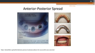 11
https://dentallabs.org/hybrid-denture-protocol-and-procedures-for-successful-case-outcome/
08/07/2024
 