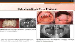 16
Hybrid Acrylic and Metal Prostheses
Egilmez, et al.: Implant-supported hybrid prosthesis in extreme cases
European Journal of Dentistry, Vol 9 / Issue 3 / Jul-Sep 2015
08/07/2024
 