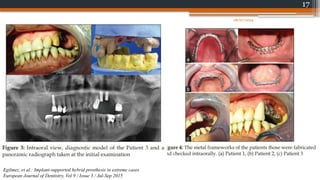 17
Egilmez, et al.: Implant-supported hybrid prosthesis in extreme cases
European Journal of Dentistry, Vol 9 / Issue 3 / Jul-Sep 2015
08/07/2024
 