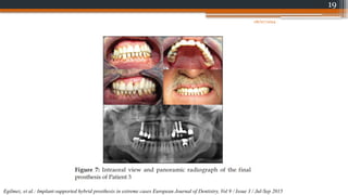 19
Egilmez, et al.: Implant-supported hybrid prosthesis in extreme cases European Journal of Dentistry, Vol 9 / Issue 3 / Jul-Sep 2015
08/07/2024
 