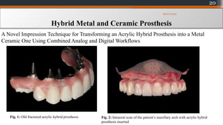 20
Hybrid Metal and Ceramic Prosthesis
A Novel Impression Technique for Transforming an Acrylic Hybrid Prosthesis into a Metal
Ceramic One Using Combined Analog and Digital Workflows
Fig. 1: Old fractured acrylic hybrid prosthesis Fig. 2: Intraoral scan of the patient’s maxillary arch with acrylic hybrid
prosthesis inserted
08/07/2024
 