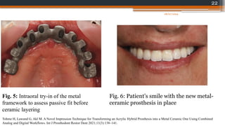 22
Fig. 5: Intraoral try-in of the metal
framework to assess passive fit before
ceramic layering
Fig. 6: Patient’s smile with the new metal-
ceramic prosthesis in place
Tohme H, Lawand G, Akl M. A Novel Impression Technique for Transforming an Acrylic Hybrid Prosthesis into a Metal Ceramic One Using Combined
Analog and Digital Workflows. Int J Prosthodont Restor Dent 2021;11(3):138–141.
08/07/2024
 