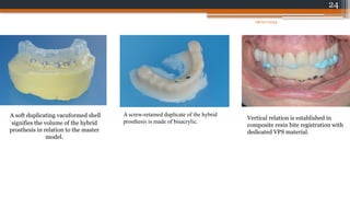 24
A soft duplicating vacuformed shell
signifies the volume of the hybrid
prosthesis in relation to the master
model.
A screw-retained duplicate of the hybrid
prosthesis is made of bisacrylic.
Vertical relation is established in
composite resin bite registration with
dedicated VPS material.
08/07/2024
 