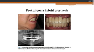 27
Peek zirconia hybrid prosthesis
08/07/2024
 