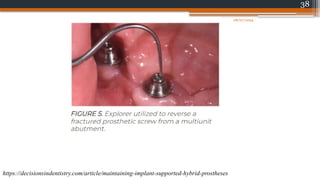 38
https://decisionsindentistry.com/article/maintaining-implant-supported-hybrid-prostheses
08/07/2024
 