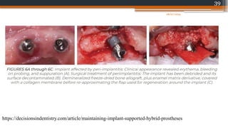 39
https://decisionsindentistry.com/article/maintaining-implant-supported-hybrid-prostheses
08/07/2024
 