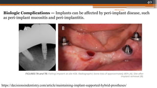 40
Biologic Complications — Implants can be affected by peri-implant disease, such
as peri-implant mucositis and peri-implantitis.
https://decisionsindentistry.com/article/maintaining-implant-supported-hybrid-prostheses/
08/07/2024
 