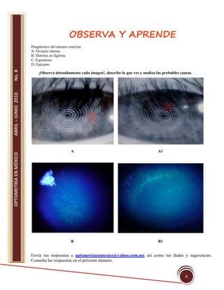 OBSERVA Y APRENDE
                       Diagnóstico del número anterior.
                       A: Orzuelo interno
                       B: Detritos en lágrima
                       C: Equimosis
                       D: Epicanto
No. 8




                           ¡Observa detenidamente cada imagen!, describe lo que ves y analiza las probables causas.
ABRIL – JUNIO 2010




                                                A                                              A1
OPTOMETRÍA EN MÉXICO




                                                B                                              B1


                       Envía tus respuestas a optometriaenmexico@yahoo.com.mx así como tus dudas y sugerencias.
                       Consulta las respuestas en el próximo número.


                                                                                                               4
 