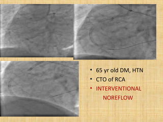 • 65 yr old DM, HTN
• CTO of RCA
• INTERVENTIONAL
NOREFLOW
 