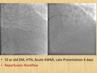 • 55 yr old DM, HTN, Acute AWMI, Late Presentation 4 days
• Reperfusion Noreflow
 