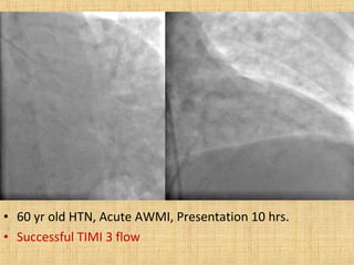 • 60 yr old HTN, Acute AWMI, Presentation 10 hrs.
• Successful TIMI 3 flow
 