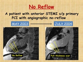 No Reflow
A patient with anterior STEMI s/p primary
PCI with angiographic no-reflow
MAY 2003 JULY 2004
Full-thickness scarNo Reflow
 