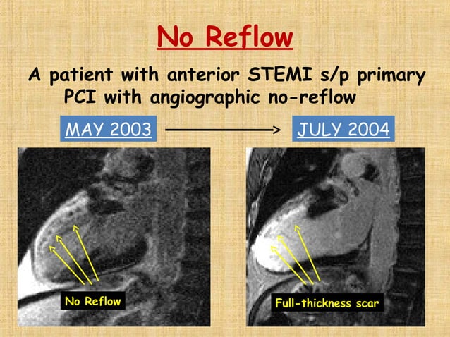 No reflow phenomenon by dr. deepchandh | PPT